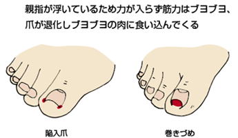 巻き爪 - 横浜の整体スクール 笠原 巖／あしけんスクール（足健検定大学）